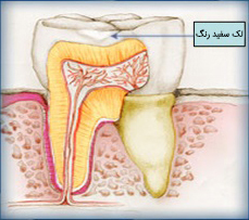 tooth decay